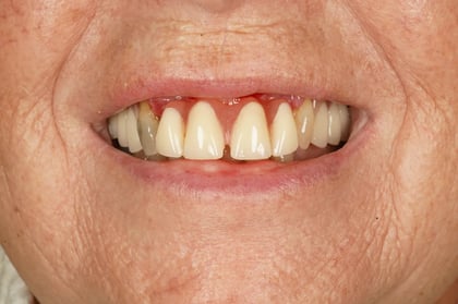 Before patient-designed replacement denture — Luna Dental, dentist in Cardiff