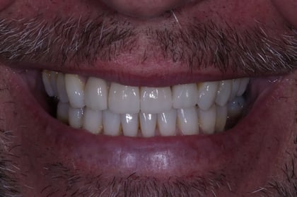 After straightened, brightened & refined — invisalign with 4 emax veneers — Luna Dental, dentist in Cardiff