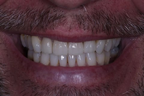 After straightened, brightened & refined — invisalign with 4 emax veneers — Luna Dental Cardiff