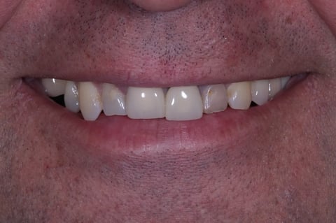 Before brighter & balanced — whitening with emax crowns & veneers — Luna Dental Cardiff