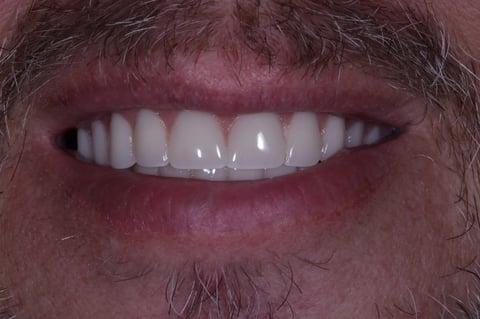 After a full reset — clearance with immediate & final upper denture — Luna Dental Cardiff