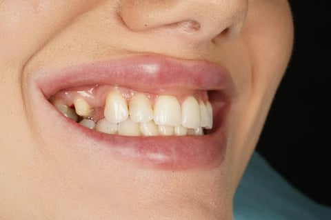 Before closing a long-standing gap with a two-unit bridge — Luna Dental Cardiff
