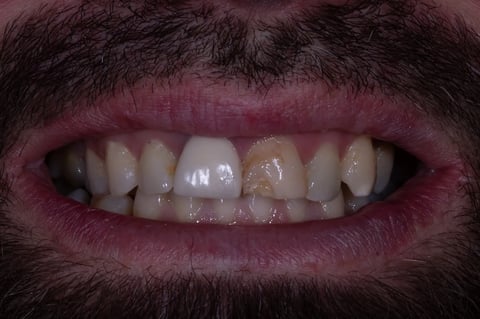 Before replacing a dark crown & restoring a chipped front tooth — Luna Dental Cardiff