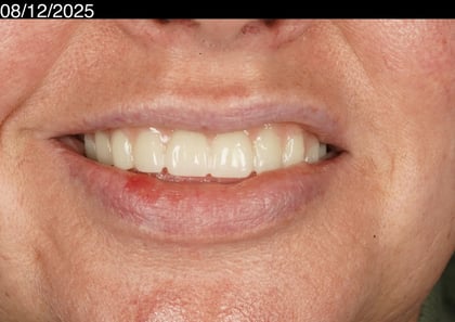 After a first smile in years — upper acrylic denture — Luna Dental, dentist in Cardiff
