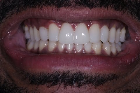 After invisalign, whitening & bonding — reshaped retained baby teeth — Luna Dental Cardiff