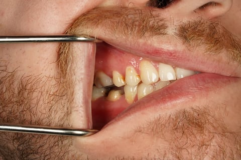 Before saved & protected — molar root canal with zirconia crown — Luna Dental Cardiff