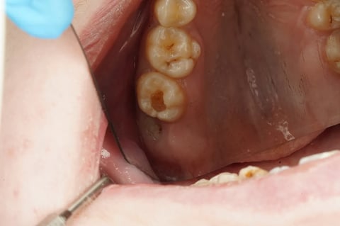 Before sensitive to bite — small cavity, composite restoration — Luna Dental Cardiff