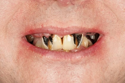 Before full mouth clearance & immediate dentures — Luna Dental, dentist in Cardiff