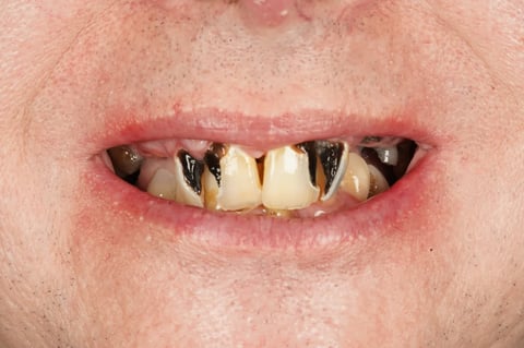 Before full mouth clearance & immediate dentures — Luna Dental Cardiff