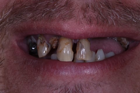 Before a full reset — clearance with immediate & final upper denture — Luna Dental Cardiff