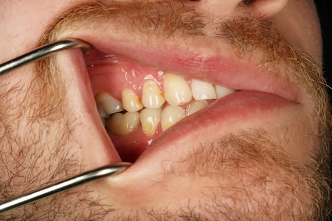 After saved & protected — molar root canal with zirconia crown — Luna Dental Cardiff