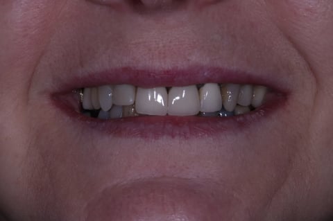 Before digital smile design — 6 layered zirconia crowns — Luna Dental Cardiff