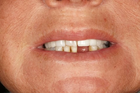 Before "nothing could be done" — small lower denture, big difference — Luna Dental Cardiff