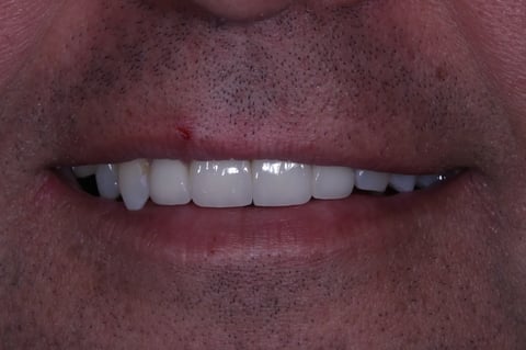 After brighter & balanced — whitening with emax crowns & veneers — Luna Dental Cardiff