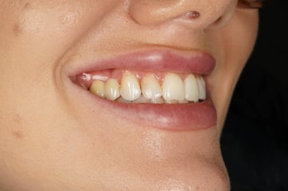 After closing a long-standing gap with a two-unit bridge — Luna Dental, dentist in Cardiff