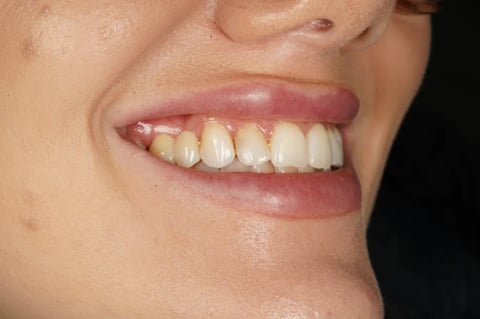 After closing a long-standing gap with a two-unit bridge — Luna Dental Cardiff