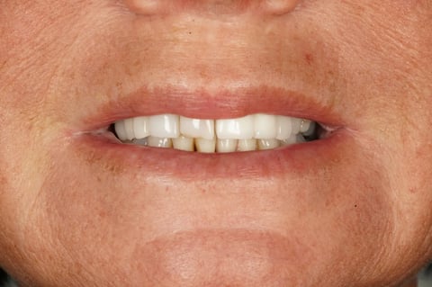 After "nothing could be done" — small lower denture, big difference — Luna Dental Cardiff