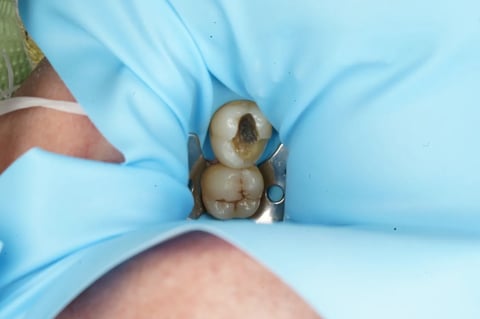 Before saving a tooth others said couldn't be saved — emax onlay — Luna Dental Cardiff