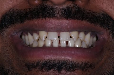 Before invisalign, whitening & bonding — reshaped retained baby teeth — Luna Dental Cardiff