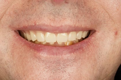 After full mouth clearance & immediate dentures — Luna Dental, dentist in Cardiff