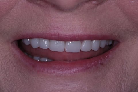 After severe wear restored — 8 zirconia crowns — Luna Dental Cardiff