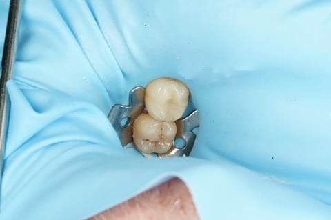 After saving a tooth others said couldn't be saved — emax onlay — Luna Dental Cardiff