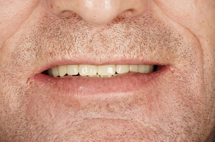 After full mouth reset — upper & lower dentures after clearance — Luna Dental, dentist in Cardiff