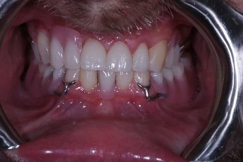 After full smile rehabilitation — crowns, bonding & cobalt chrome dentures — Luna Dental Cardiff
