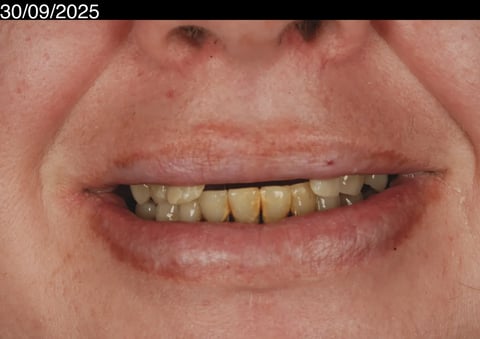 Before a fresh start — upper clearance with lower hygiene — Luna Dental Cardiff