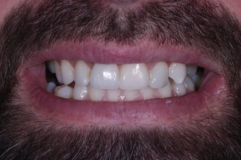 After replacing a dark crown & restoring a chipped front tooth — Luna Dental Cardiff