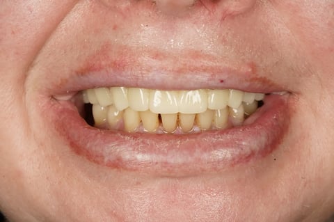After a fresh start — upper clearance with lower hygiene — Luna Dental Cardiff