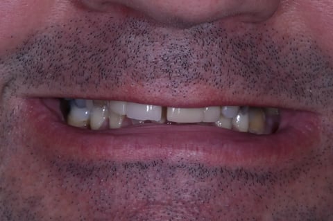 Before refreshed & rebuilt — whitening with 6 emax crowns — Luna Dental Cardiff