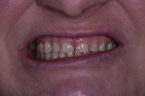 Before severe wear restored — 8 zirconia crowns — Luna Dental Cardiff