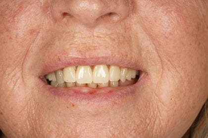 After patient-designed replacement denture — Luna Dental, dentist in Cardiff