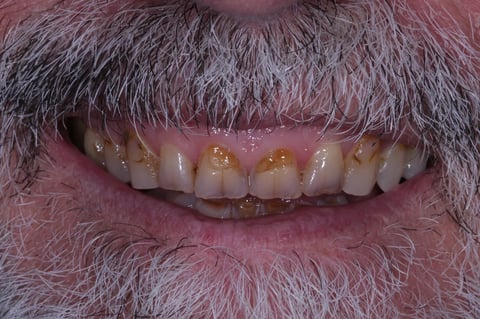 Before rebuilt & refreshed — composite bonding on 6 front teeth — Luna Dental Cardiff