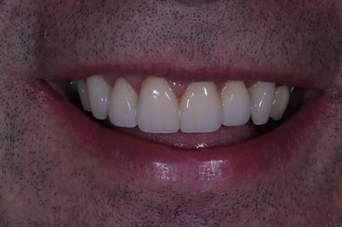 After rebuilt front teeth — whitening with zirconia crowns & bridge — Luna Dental Cardiff