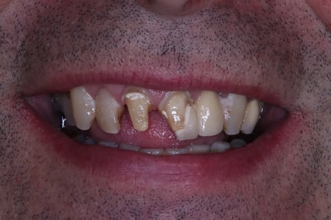 Before rebuilt front teeth — whitening with zirconia crowns & bridge — Luna Dental Cardiff