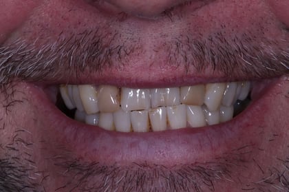 Before straightened, brightened & refined — invisalign with 4 emax veneers — Luna Dental, dentist in Cardiff