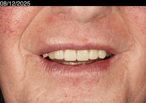 After a more secure smile — cobalt chrome denture — Luna Dental Cardiff