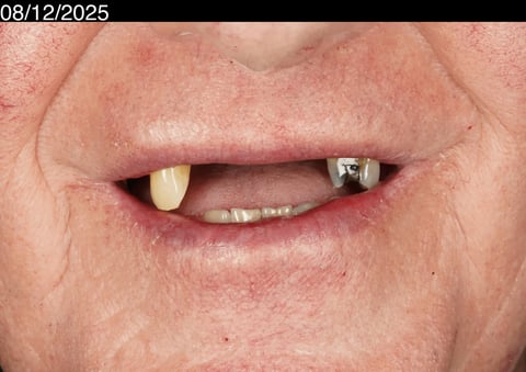 Before a more secure smile — cobalt chrome denture — Luna Dental Cardiff