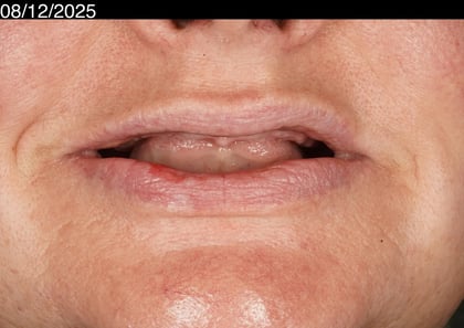 Before a first smile in years — upper acrylic denture — Luna Dental, dentist in Cardiff