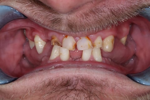 Before full smile rehabilitation — crowns, bonding & cobalt chrome dentures — Luna Dental Cardiff
