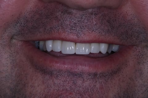After refreshed & rebuilt — whitening with 6 emax crowns — Luna Dental Cardiff