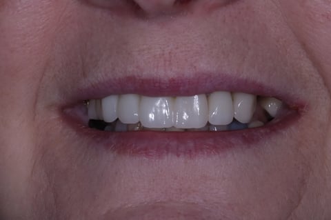 After digital smile design — 6 layered zirconia crowns — Luna Dental Cardiff