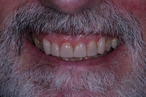 After rebuilt & refreshed — composite bonding on 6 front teeth — Luna Dental Cardiff