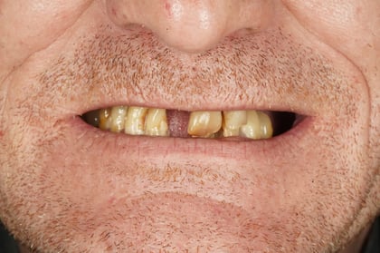 Before full mouth reset — upper & lower dentures after clearance — Luna Dental, dentist in Cardiff