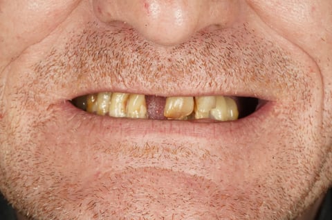 Before full mouth reset — upper & lower dentures after clearance — Luna Dental Cardiff