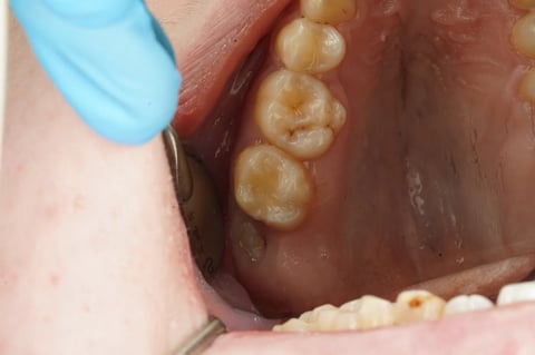 After sensitive to bite — small cavity, composite restoration — Luna Dental Cardiff